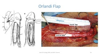 Orlandi Flap
Dept Of Urology, KMC and GRH, Chennai 56
 