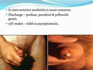  In men anterior urethritis is more common.

 Discharge – profuse, purulent & yellowish

green.
 15% males – mild or asymptomatic.

 
