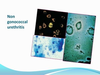 Non
gonococcal
urethritis

 