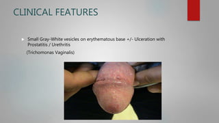 CLINICAL FEATURES
 Small Gray-White vesicles on erythematous base +/- Ulceration with
Prostatitis / Urethritis
(Trichomonas Vaginalis)
 