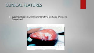 CLINICAL FEATURES
 Superficial Erosions with Purulent Urethral Discharge (Neisseria
Gonorrhoea)
 