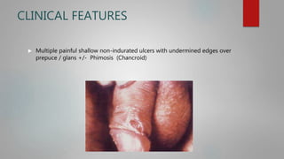 CLINICAL FEATURES
 Multiple painful shallow non-indurated ulcers with undermined edges over
prepuce / glans +/- Phimosis (Chancroid)
 