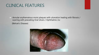CLINICAL FEATURES
 Annular erythematous moist plaques with ulceration healing with fibrosis /
scarring with preceding Oral Ulcers / Ophthalmic inv
(Behcet’s Disease)
 