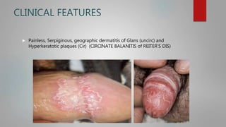 CLINICAL FEATURES
 Painless, Serpiginous, geographic dermatitis of Glans (uncirc) and
Hyperkeratotic plaques (Cir) (CIRCINATE BALANITIS of REITER’S DIS)
 