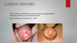 CLINICAL FEATURES
 Chronic inflamm followed by atrophic sclerosis, depigmentation,
induration, phimosis and Urethral Stricture
(Lichen Sclerosus et Atrophicans / BXO)
 