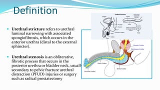 Definition
 Urethral stricture refers to urethral
luminal narrowing with associated
spongiofibrosis, which occurs in the
anterior urethra (distal to the external
sphincter).
 Urethral stenosis is an obliterative,
fibrotic process that occurs in the
posterior urethra or bladder neck, usually
secondary to pelvic fracture urethral
distraction (PFUD) injuries or surgery
such as radical prostatectomy
 