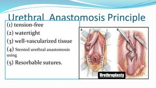 Urethral Anastomosis Principle
(1) tension-free
(2) watertight
(3) well-vascularized tissue
(4) Stented urethral anastomosis
using
(5) Resorbable sutures.
 