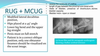 RUG + MCUG
 Modified lateral decubitus
position,
 Hips placed at a 45° angle
 Lower leg bend and the upper
leg straight
 Penis must on full stretch
 Patient is in a correct oblique
position, only one obturator
foramen should be visualized on
the scout image.
(a) Scout film and (b) retrograde urethrogram
showing a bulbar urethral stricture
• assess the continuity of urethra
• length of gap between the proximal and distal ends
• State of bladder, presence of diverticulum, stones
• bladder capacity
• Bladder neck—open or closed
 