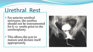 Urethral Rest
 For anterior urethral
strictures, the urethra
should not be instrumented
for 6–12 weeks prior to the
urethroplasty.
 This allows the scar to
mature and declare itself
appropriately
 