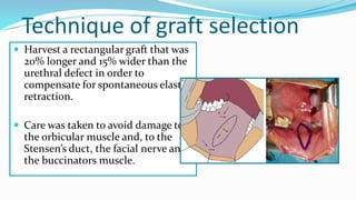 Technique of graft selection
 Harvest a rectangular graft that was
20% longer and 15% wider than the
urethral defect in order to
compensate for spontaneous elastic
retraction.
 Care was taken to avoid damage to
the orbicular muscle and, to the
Stensen’s duct, the facial nerve and
the buccinators muscle.
 
