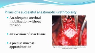 Pillars of a successful anastomotic urethroplasty
 An adequate urethral
mobilization without
tension
 an excision of scar tissue
 a precise mucosa
approximation
 