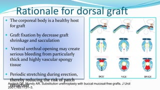 Rationale for dorsal graft
 The corporeal body is a healthy host
for graft
 Graft fixation by decrease graft
shrinkage and sacculation
 Ventral urethral opening may create
serious bleeding from particularly
thick and highly vascular spongy
tissue
 Periodic stretching during erection,
thereby reducing the risk of patch
retraction
Andrich DE, Mundy AR. Substitution urethroplasty with buccal mucosal-free grafts. J Urol
2001;165:1131–3.
 
