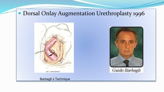  Dorsal Onlay Augmentation Urethroplasty 1996
Barbagli`s Technique
 