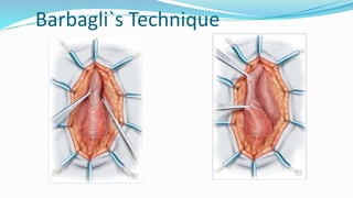 Barbagli`s Technique
 