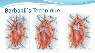 Barbagli`s Technique
 
