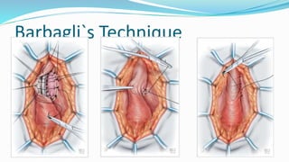Barbagli`s Technique
 