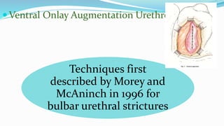  Ventral Onlay Augmentation Urethroplasty
Techniques first
described by Morey and
McAninch in 1996 for
bulbar urethral strictures
 