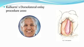  Kulkarni`s Dorsolateral onlay
procedure 2000
 