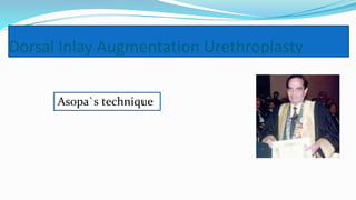 Dorsal Inlay Augmentation Urethroplasty
Asopa`s technique
 