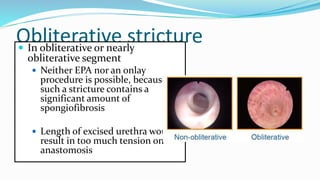Obliterative stricture
 In obliterative or nearly
obliterative segment
 Neither EPA nor an onlay
procedure is possible, because
such a stricture contains a
significant amount of
spongiofibrosis
 Length of excised urethra would
result in too much tension on
anastomosis
 