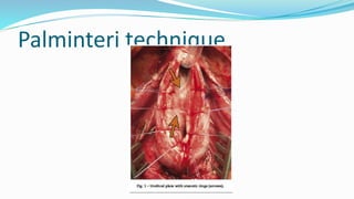 Palminteri technique
 