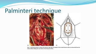 Palminteri technique
 