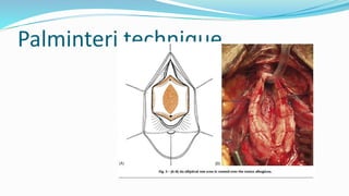 Palminteri technique
 