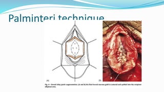 Palminteri technique
 