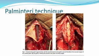 Palminteri technique
 