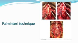 Palminteri technique
 