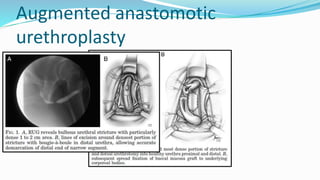 Augmented anastomotic
urethroplasty
 