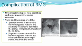 Complication of BMG
 Urethrocele with post-void dribbling
and semen sequestration are
common
 Yucel and Baskin reported that
 perineal nerves innervate the
bulbospongiosus muscles and
send fine branches to penetrate
the corpus spongiosum, muscles in
the midline.
 Rhythmic contractions of the
bulbospongiosus muscles and
other perineal muscles expel
semen and from the urethra
 