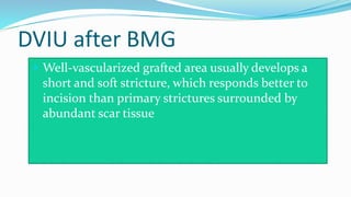 DVIU after BMG
 Well-vascularized grafted area usually develops a
short and soft stricture, which responds better to
incision than primary strictures surrounded by
abundant scar tissue
 