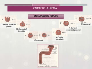 CALIBRE DE LA URETRA
EN ESTADO DE REPOSO
1.Vertical a nivel del
glande
2.En forma de T
invertida
3.Transversal
4. Curva de
concavidad posterior
5.Transversal
6.Circular,
estrellada