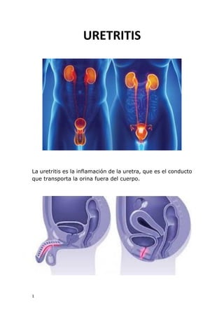 1
URETRITIS
La uretritis es la inflamación de la uretra, que es el conducto
que transporta la orina fuera del cuerpo.
 