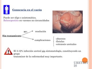-abscesos -fístulas -estenosis uretrales Puede ser oligo o asintomática. Balanopostitis  en varones no circuncidados El 3-12% infección uretral  sin  sintomatología, constituyendo un grupo transmisor de la enfermedad muy importante. Gonococia en el varón URETRITIS Sin tratamiento 95%  resolución  complicaciones 