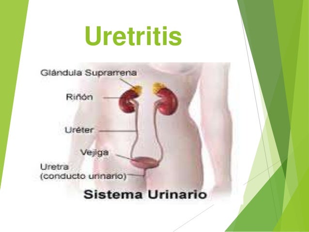 Uretritis gonocócica y no gonocócica