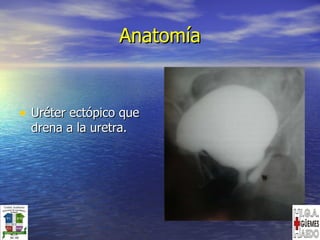 Anatomía Uréter ectópico que drena a la uretra. 