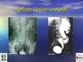 Reflujo Vésico-Ureteral 