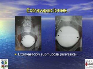 Extravasaciones Extravasación submucosa perivesical. 