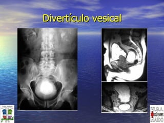 Divertículo vesical 