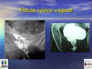 Fístula vésico-vaginal 