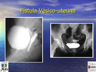 Fístula Vésico-uterina 