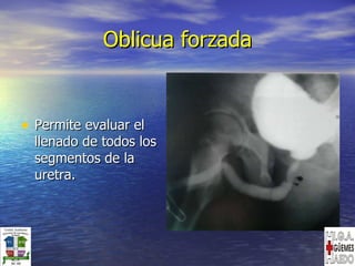 Oblicua forzada Permite evaluar el llenado de todos los segmentos de la uretra. 