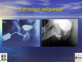 Estrechez adquirida 