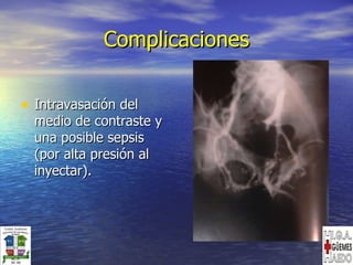 Complicaciones Intravasación del medio de contraste y una posible sepsis (por alta presión al inyectar). 