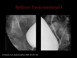 Fernbach et al. RadioGraphics 2000; 20:155–168
 
