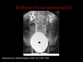 Berrocal et al. RadioGraphics 2002; 22:1139–1164.
 