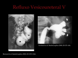 Berrocal et al. RadioGraphics 2002; 22:1139–1164.
Fernbach et al. RadioGraphics 2000; 20:155–168.
 