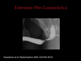 Kawashima et al. RadioGraphics 2004; 24:S195–S216.
 